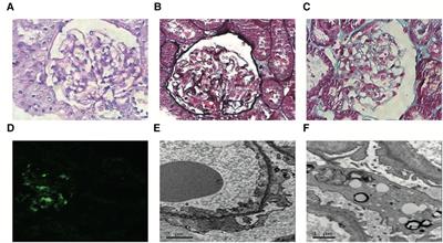 Steroid-resistant nephrotic syndrome associated with certain SGPL1 variants in a family: Case report and literature review